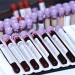 血液検査1回でがん8種を発見